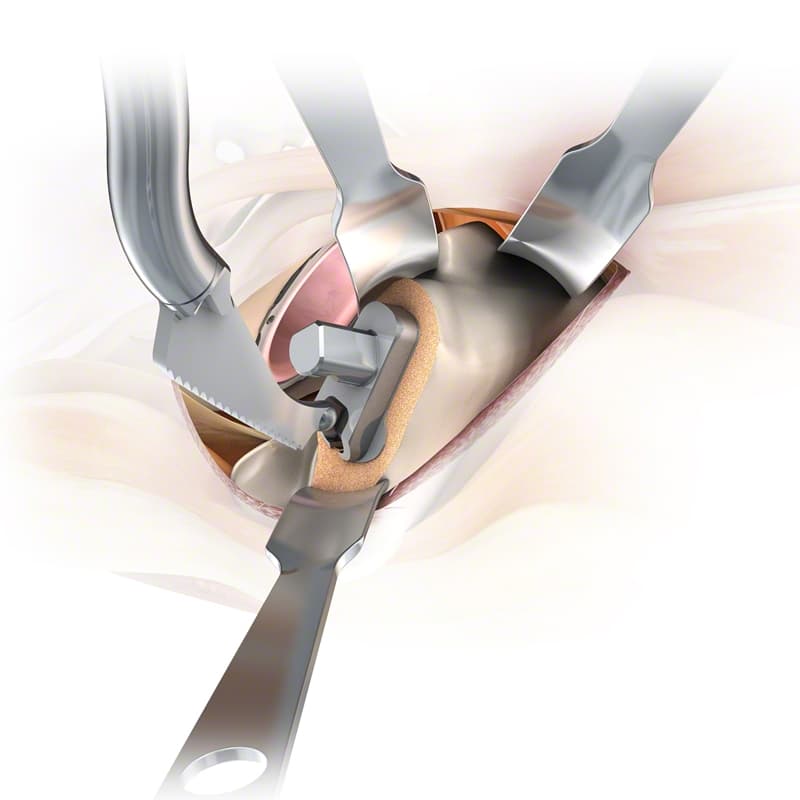 MIOS® Hip-Product Picture Enlargement CW