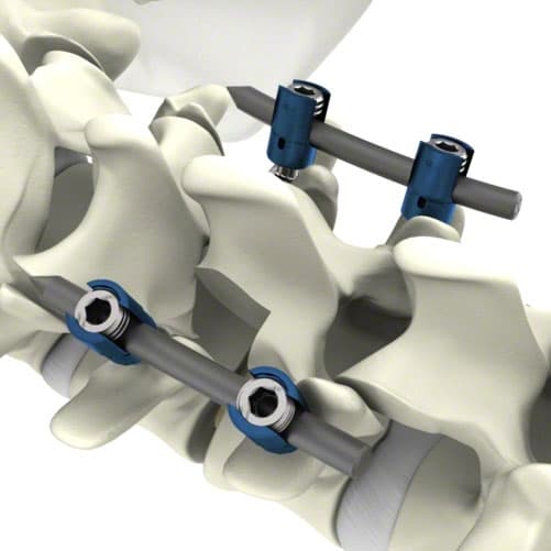 S4® Spinal System-Product Picture Enlargement CW