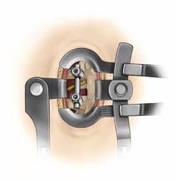 Spine Classics MLD System-Product Picture Enlargement CW
